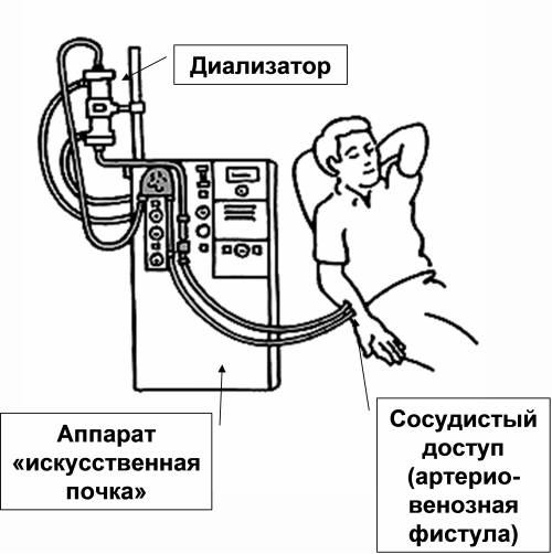 Принцип работы аппарата искусственная почка рисунок