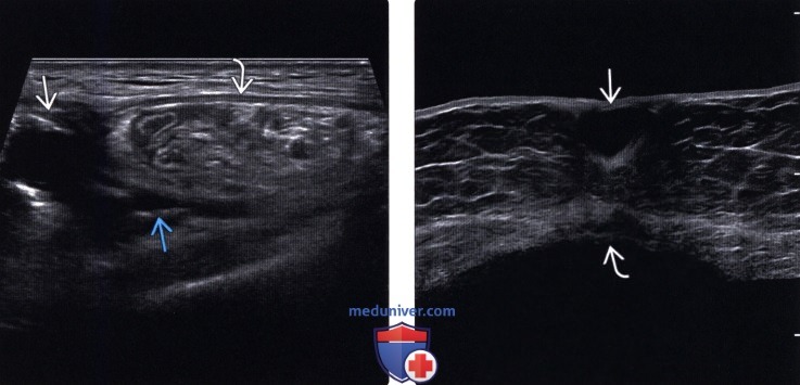 Узи стенок. Гематома передней брюшной стенки на УЗИ. УЗИ мягких тканей передней брюшной стенки протокол. Серома передней брюшной стенки на УЗИ. Гематома передней брюшной стенки мягких тканей на УЗИ.