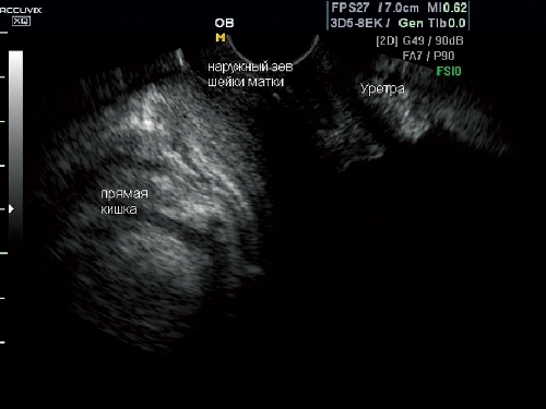 Выпадение матки после родов. Опущение матки диагностика УЗИ. Опущение органов малого таза на УЗИ.