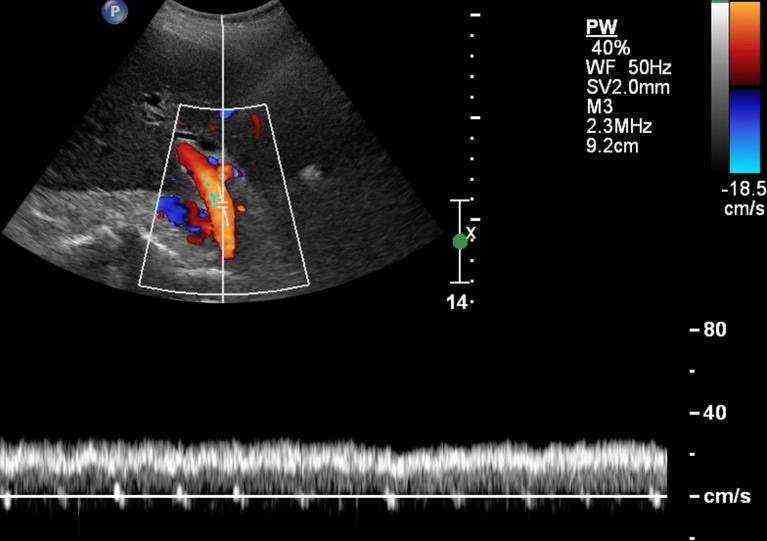 Измерение кровотока. Допплерометрия воротной вены. Воротная Вена печени на УЗИ. Воротная Вена допплер.