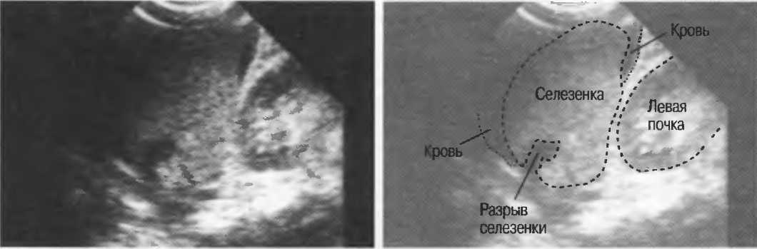Жидкость в селезенке. Подкапсульный разрыв селезенки на УЗИ. УЗИ картина травмы селезенки. УЗИ картина при разрыве селезенки.