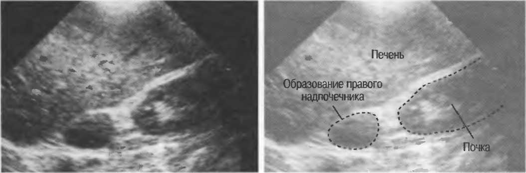 Ультразвуковое исследование надпочечников