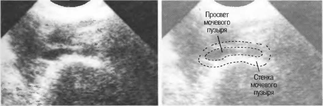 Утолщение стенки мочевого пузыря при узи. Уплотнение стенки мочевого пузыря. Отслойка слизистой мочевого пузыря узи. Расширение устья мочеточника в мочевом пузыре на узи. Узи мочевого пузыря показатели в норме.