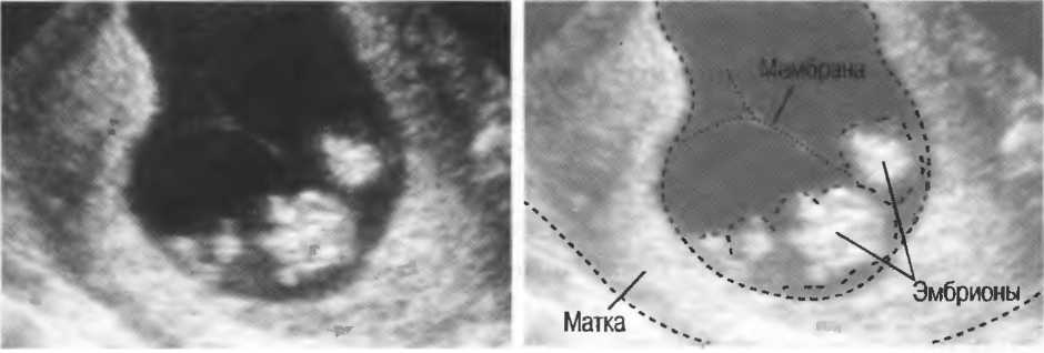 Подсадили эмбрион форум. Эмбрион в матке после переноса на УЗИ. Матка и эмбрион после эко. Имплантация эмбриона на УЗИ.