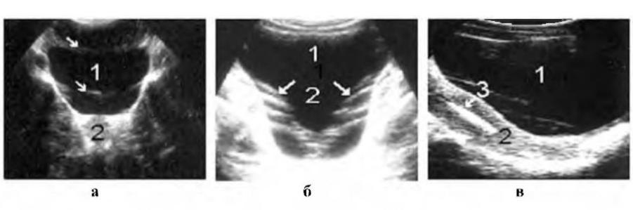 Узи мочевой простаты. Сонограмма предстательной железы. Деформация шейки мочевого пузыря на УЗИ. Стенки мочевого пузыря на УЗИ анатомия. Толщина стенки мочевого пузыря при УЗИ В норме.